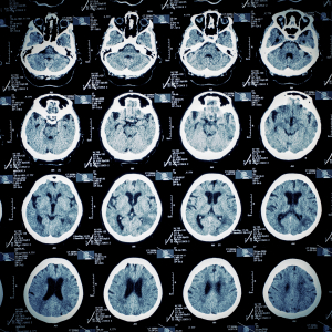 MRI of brain - TBI